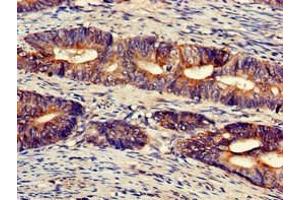 Immunohistochemistry of paraffin-embedded human colon cancer using ABIN7174508 at dilution of 1:100 (UFM1 Antikörper  (AA 11-63))