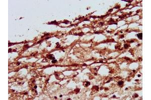 IHC image of ABIN7162742 diluted at 1:500 and staining in paraffin-embedded human melanoma performed on a Leica BondTM system. (SLC26A4 Antikörper  (AA 592-655))