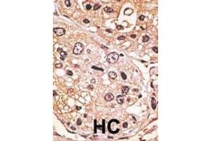 Formalin-fixed and paraffin-embedded human cancer tissue reacted with the primary antibody, which was peroxidase-conjugated to the secondary antibody, followed by AEC staining. (GDF9 Antikörper  (N-Term))