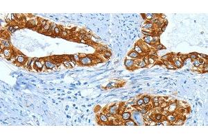 Immunohistochemistry of paraffin-embedded Human cervical cancer using KRT40 Polyclonal Antibody at dilution of 1:50 (KRT40 Antikörper)