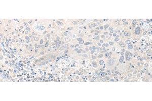 Immunohistochemistry of paraffin-embedded Human cervical cancer tissue using TIMM8A Polyclonal Antibody at dilution of 1:50(x200) (TIMM8A/DDP Antikörper)