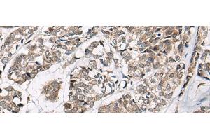 Immunohistochemistry of paraffin-embedded Human esophagus cancer tissue using CACNB3 Polyclonal Antibody at dilution of 1:55(x200) (CACNB3 Antikörper)