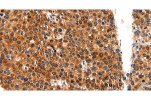 Immunohistochemistry of paraffin-embedded Human liver cancer tissue using FGFR1 Polyclonal Antibody at dilution 1:60 (FGFR1 Antikörper)