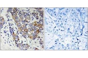 Immunohistochemistry analysis of paraffin-embedded human breast carcinoma tissue, using CBR1 Antibody. (CBR1 Antikörper  (AA 181-230))