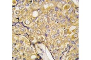 IHC analysis of FFPE human prostate carcinoma tissue stained with TRPM8 antibody (TRPM8 Antikörper  (AA 521-552))