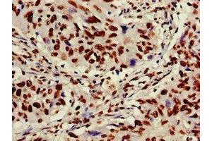Immunohistochemistry of paraffin-embedded human lung cancer using ABIN7175905 at dilution of 1:100 (XRCC6 Antikörper  (AA 2-609))