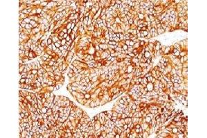 Formalin-fixed, paraffin-embedded human colon carcinoma stained with Cytokeratin 18 antibody.