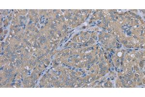 Immunohistochemistry of paraffin-embedded Human thyroid cancer using EZR Polyclonal Antibody at dilution of 1:30 (Ezrin Antikörper)