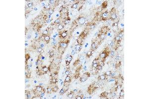 Immunohistochemistry of paraffin-embedded human liver using IGF2BP3 antibody (ABIN6131800, ABIN6142245, ABIN6142246 and ABIN6221706) at dilution of 1:100 (40x lens).