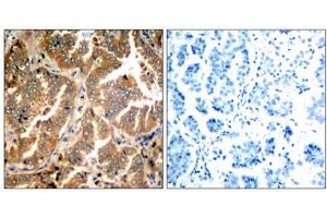 Immunohistochemical analysis of paraffin- embedded human lung carcinoma tissue using ADD1 (Ab-726) antibody (E021189). (alpha Adducin Antikörper)