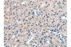 The image on the left is immunohistochemistry of paraffin-embedded Human liver cancer tissue using ABIN7127970(ITPA Antibody) at dilution 1/25, on the right is treated with fusion protein. (ITPA Antikörper)
