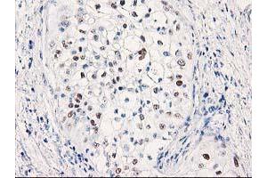 Immunohistochemistry (IHC) image for anti-Tumor Protein P53 (TP53) antibody (ABIN1499971) (p53 Antikörper)