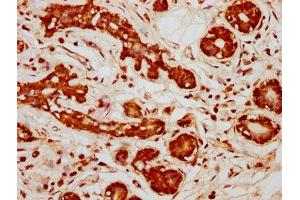 IHC image of ABIN7169260 diluted at 1:333 and staining in paraffin-embedded human breast cancer performed on a Leica BondTM system.