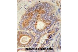 HHAT Antibody (N-term) (ABIN651694 and ABIN2840363) immunohistochemistry analysis in formalin fixed and paraffin embedded human prostate carcinoma followed by peroxidase conjugation of the secondary antibody and DAB staining.