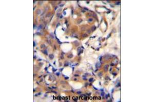 KNG1 Antibody immunohistochemistry analysis in formalin fixed and paraffin embedded human breast carcinoma followed by peroxidase conjugation of the secondary antibody and DAB staining. (KNG1 Antikörper  (N-Term))