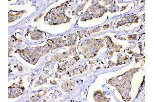 MUT was detected in paraffin-embedded sections of human lung cancer tissues using rabbit anti- MUT Antigen Affinity purified polyclonal antibody (Catalog # ) at 1 µg/mL. (MUT Antikörper  (N-Term))