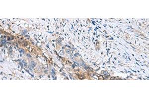 Immunohistochemistry of paraffin-embedded Human cervical cancer tissue using RNF208 Polyclonal Antibody at dilution of 1:55(x200) (RNF208 Antikörper)