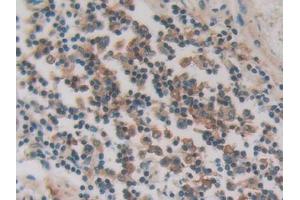 IHC-P analysis of Human Stomach cancer Tissue, with DAB staining. (PKIG Antikörper  (AA 1-76))