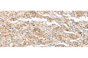 Immunohistochemistry of paraffin-embedded Human cervical cancer tissue using TTC12 Polyclonal Antibody at dilution of 1:40(x200) (TTC12 Antikörper)