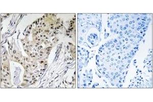 Immunohistochemistry analysis of paraffin-embedded human breast carcinoma tissue, using POLE4 Antibody. (POLE4 Antikörper  (AA 61-110))