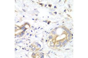 Immunohistochemistry of paraffin-embedded human liver cancer using TXN2 antibody at dilution of 1:100 (x40 lens). (TXN2 Antikörper)