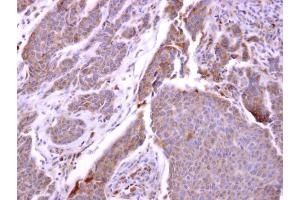 IHC-P Image CXCR1 antibody [C2C3], C-term detects CXCR1 protein at cytosol on human breast carcinoma by immunohistochemical analysis. (CXCR1 Antikörper  (C-Term))