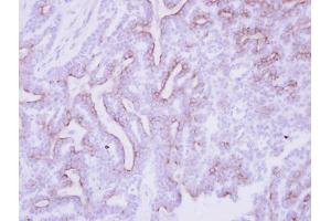 IHC-P Image Immunohistochemical analysis of paraffin-embedded human breast cancer, using CDO, antibody at 1:250 dilution. (CDON Antikörper  (N-Term))