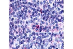 Anti-GPR65 antibody  ABIN1048859 IHC staining of human lymph node, hodgkin's disease. (GPR65 Antikörper  (Cytoplasmic Domain))