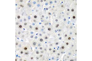 Immunohistochemistry of paraffin-embedded human liver cancer using LMX1B antibody (ABIN5975264) at dilution of 1/200 (40x lens). (LMX1B Antikörper)