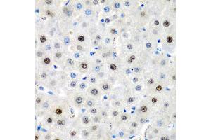 Immunohistochemistry of paraffin-embedded human liver cancer using LMX1B antibody (ABIN5975264) at dilution of 1/200 (40x lens).