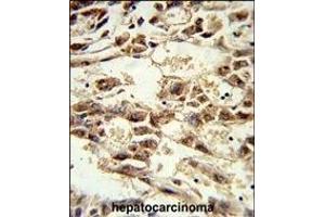 Formalin-fixed and paraffin-embedded human hepatocarcinoma reacted with AIFM2 Antibody (C-term), which was peroxidase-conjugated to the secondary antibody, followed by DAB staining. (AIFM2 Antikörper  (C-Term))