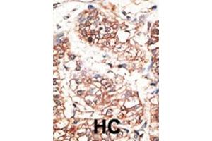 Formalin-fixed and paraffin-embedded human cancer tissue reacted with the primary antibody, which was peroxidase-conjugated to the secondary antibody, followed by AEC staining. (Neuregulin 3 Antikörper  (AA 305-336))