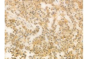 ABIN6264332 and ABIN6276815 at 1/100 staining human pituitary adenoma by IHC-P.