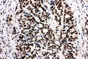 Anti-Ku80 antibody, IHC(P) IHC(P): Human Mammary Cancer Tissue