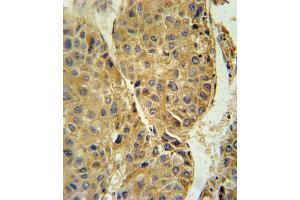 TUBB3 Antibody (N-term) (ABIN651938 and ABIN2840464) immunohistochemistry analysis in formalin fixed and paraffin embedded human hepatocarcinoma followed by peroxidase conjugation of the secondary antibody and DAB staining. (TUBB3 Antikörper  (AA 36-63))