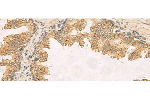 Immunohistochemistry of paraffin-embedded Human prost ate cancer tissue using RPS11 Polyclonal Antibody at dilution of 1:40(x200) (RPS11 Antikörper)
