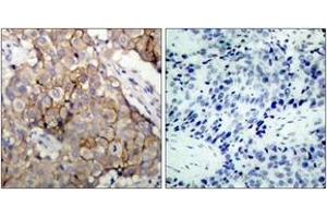 Immunohistochemistry analysis of paraffin-embedded human breast carcinoma tissue, using EGFR (Ab-1092) Antibody. (EGFR Antikörper  (AA 1061-1110))