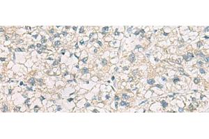 Immunohistochemistry of paraffin-embedded Human liver cancer tissue using CHMP6 Polyclonal Antibody at dilution of 1:65(x200) (CHMP6 Antikörper)