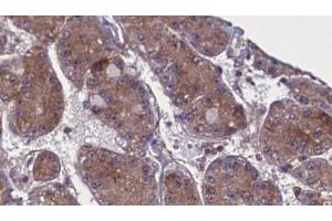 ABIN6277722 at 1/100 staining Human liver cancer tissue by IHC-P. (SPRY4 Antikörper  (Internal Region))