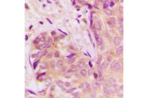 Immunohistochemical analysis of TGF beta 1 staining in human breast cancer formalin fixed paraffin embedded tissue section. (TGFB1 Antikörper  (C-Term))