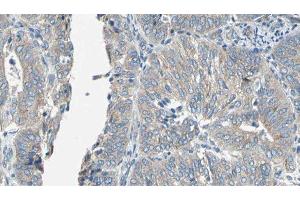 ABIN6276939 at 1/100 staining Human cervical cancer tissue by IHC-P. (EPXH2 Antikörper)