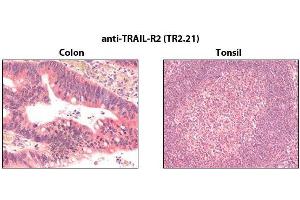 Immunohistochemistry detection of endogenous TRAIL-R2 in paraffin-embedded human carcinoma tissues (colon, tonsil) using mAb to TRAIL-R2 (TR2. (TNFRSF10B Antikörper)