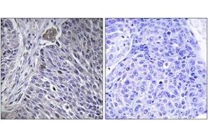 Immunohistochemistry analysis of paraffin-embedded human lung carcinoma tissue, using HNRPDL Antibody. (HNRPDL Antikörper  (AA 241-290))
