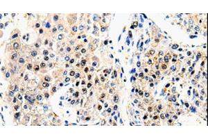 Immunohistochemistry of paraffin-embedded Human liver cancer using beta Amyloid Polyclonal Antibody at dilution of 1:100 (beta Amyloid Antikörper)