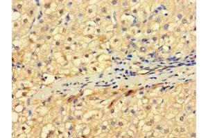 Immunohistochemistry of paraffin-embedded human liver cancer using ABIN7151164 at dilution of 1:100 (RNF182 Antikörper  (AA 1-160))