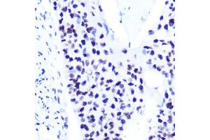Immunohistochemistry of paraffin-embedded human esophageal cancer using Phospho-ST-S727 Rabbit mAb (ABIN7270300) at dilution of 1:100 (40x lens). (STAT1 Antikörper  (pSer727))