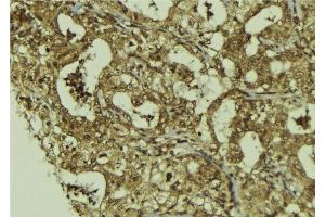 ABIN6273227 at 1/100 staining Human breast cancer tissue by IHC-P.