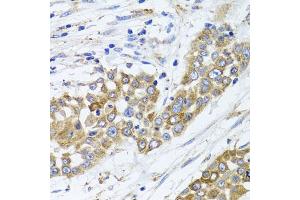 Immunohistochemistry of paraffin-embedded human colon carcinoma using PEX14 antibody. (PEX14 Antikörper)