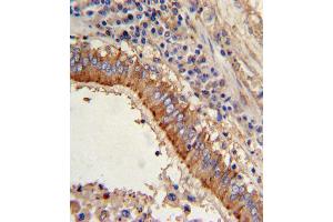 Formalin-fixed and paraffin-embedded human lung carcinoma with MVP Antibody (C-term), which was peroxidase-conjugated to the secondary antibody, followed by DAB staining.