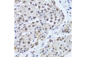 Immunohistochemistry of paraffin-embedded human lung cancer using TP53BP1 antibody (ABIN5973380) at dilution of 1/100 (40x lens). (TP53BP1 Antikörper)